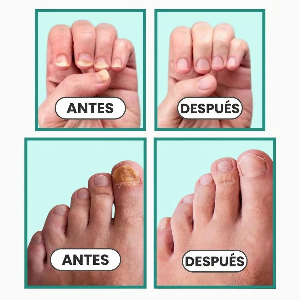 Dispositivo Nivora para Hongos en Uñas